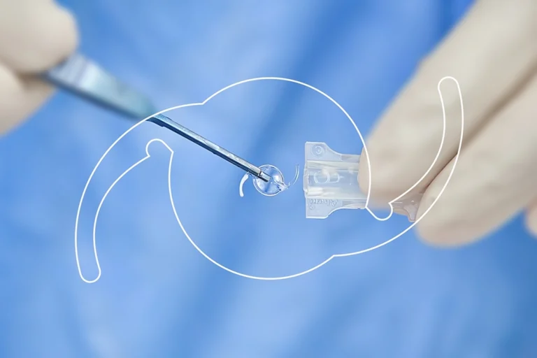 “Cataract lens selection guide to help patients choose the right IOL.