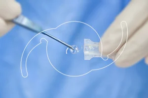 Guide to choosing the right cataract lens for surgery.