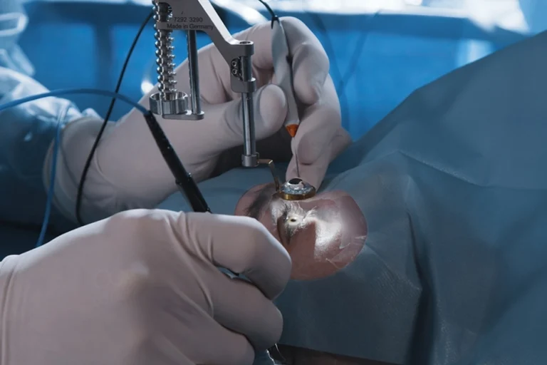 Comparison of traditional LASIK and lenticule extraction for vision correction.